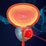 cirugiia-de-prostata-con-laser
