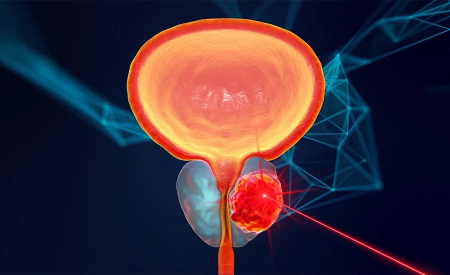cirugiia-de-prostata-con-laser